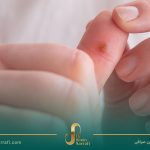 راهنمای جامع درمان زگیل: روشهای مختلف درمانی