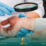 راهنمای جامع کراتوزهای پوستی: روشهای مختلف درمانی