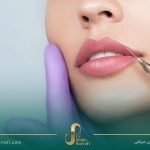 فیلر و ژل لب: راز داشتن لب‌هایی طبیعی و جذاب