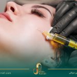 PRP برای درمان ریزش مو